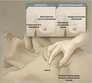 Гинекомастия у мужского населения